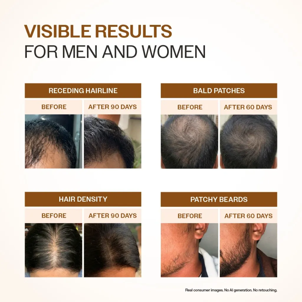 Advanced Hair Growth Serum With 3% Redensyl, 4% Anagain, & 1% Capilia Longa - 30 ml4.webp